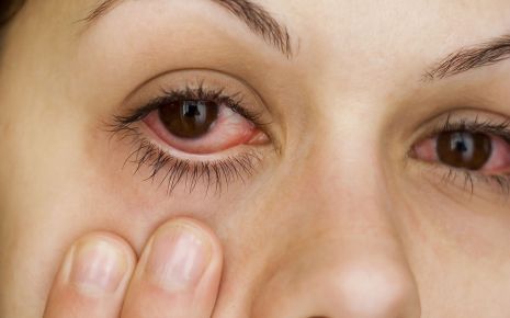 Blepharitis: Man sieht eine Frau mit entzündeten Augen.
