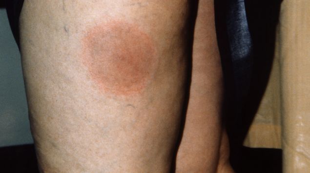 Borreliose Symptome Und Behandlung Der Zeckenbiss Infektion