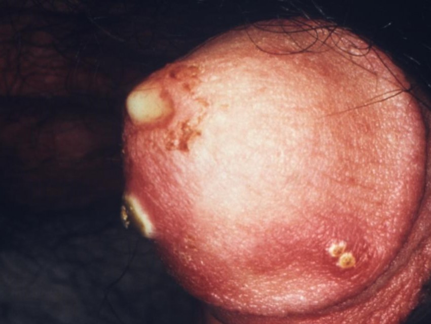 Natural cervicitis tratamiento cronica moderada