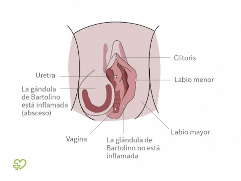 diabetes de síntomas de ciste de Bartholin diabetes de síntomas de ciste de Bartholin