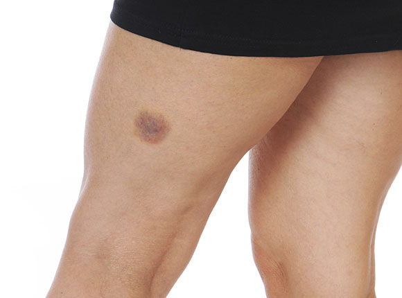 Cuanto tarda en desaparecer un hematoma en el embarazo
