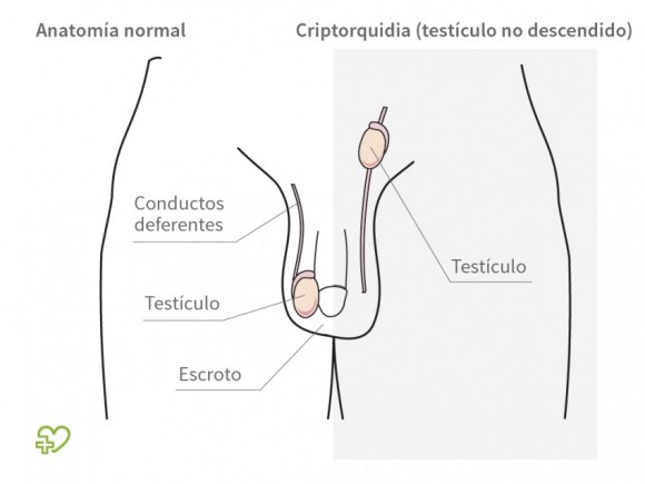 Resultado de imaxes para criptorquidia