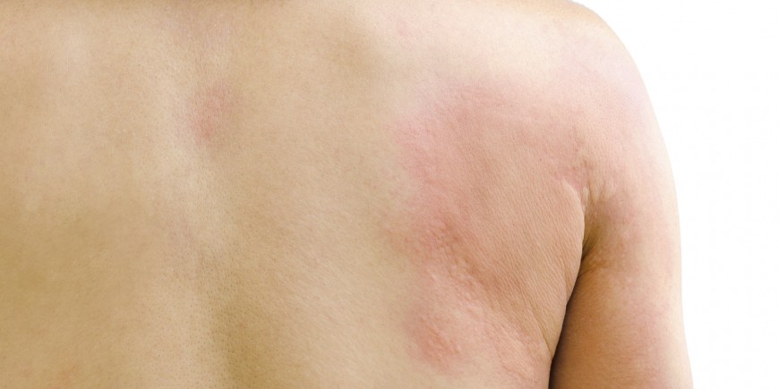 dermatitis en piernas de bebe
