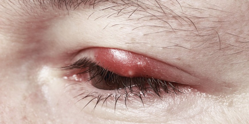 síntomas de diabetes gerstenkorn auge