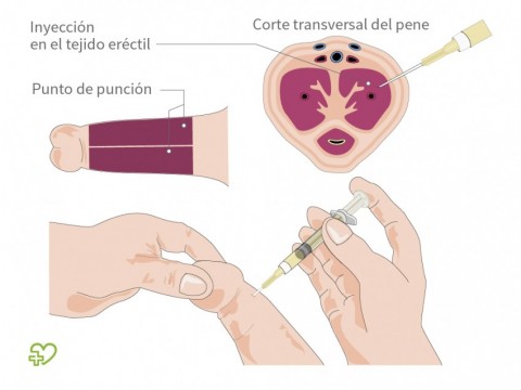 punción contra la disfunción eréctil punción contra la disfunción eréctil