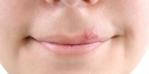 Ve herpes de comienzo ¿Cómo se el labial? un