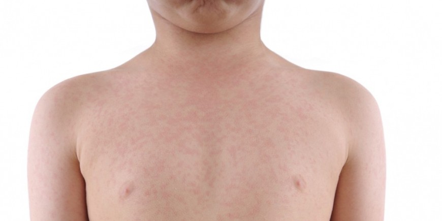 Urticaria y perdida de peso