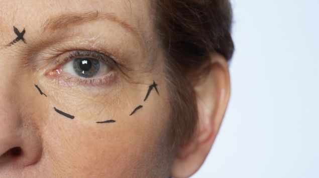 Teil eines Frauengesichts mit eingezeichneten Facelift-Marken