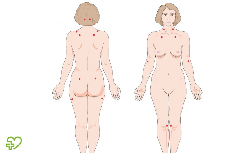 Schmerz-Druckpunkte (Tender Points) bei Fibromyalgie