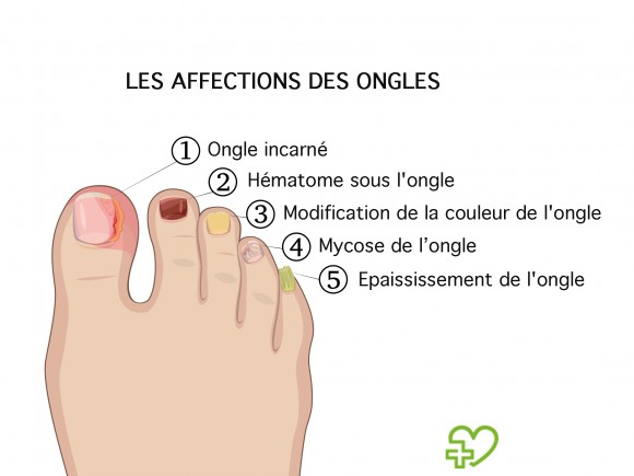 Taches Blanches Sur Les Ongles Lalimentation En Cause