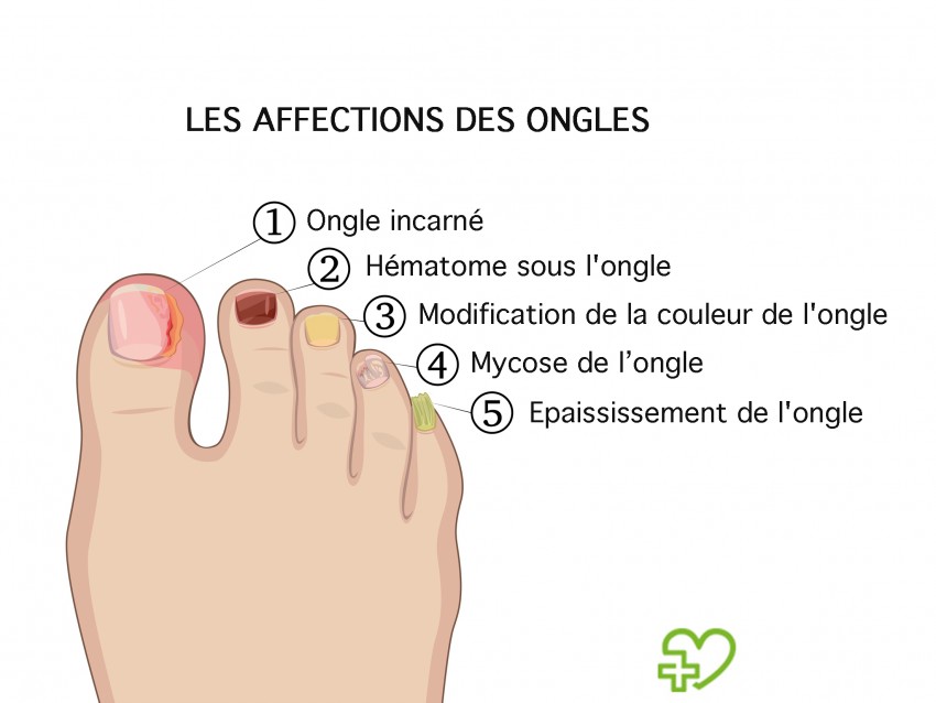 Ongle Incarne Le Soigner Efficacement Et Eviter Une Recidive Onmeda Fr