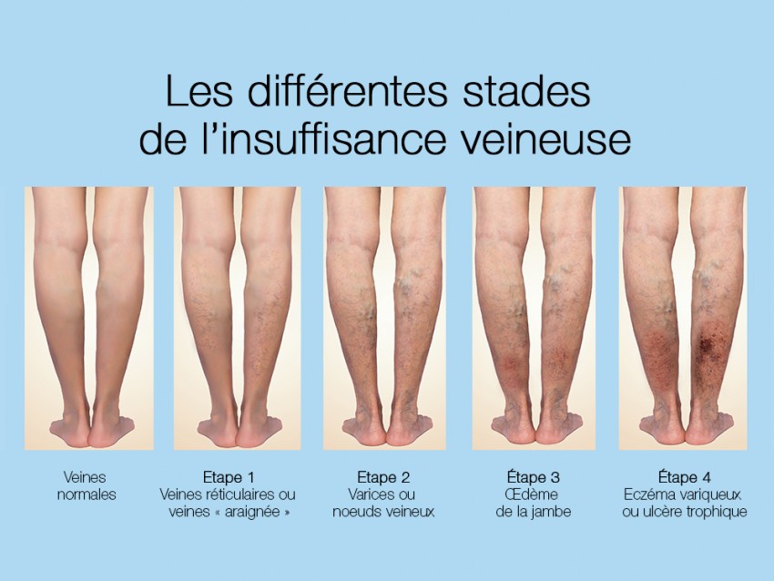 mauvaise circulation sanguine traitement mauvaise circulation sanguine traitement