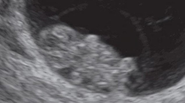 Entwicklung Embryo Fotus Baby Onmeda De