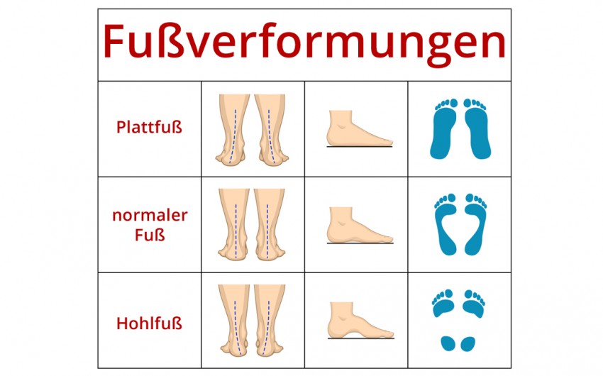 Im Vergleich: Abdruck und Profil verschiedner Fußformen