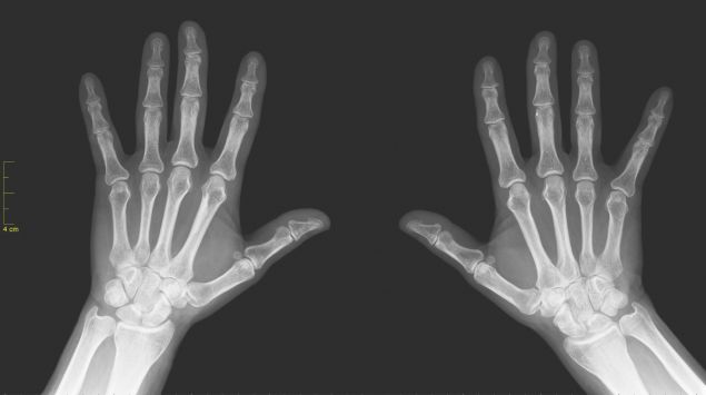 Röntgenaufnahme einer rechten und linken Hand.