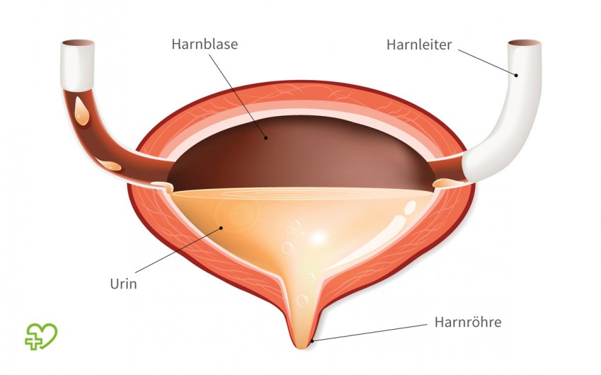 Blasenschmerzen Ursachen Diagnose Therapie Onmeda De