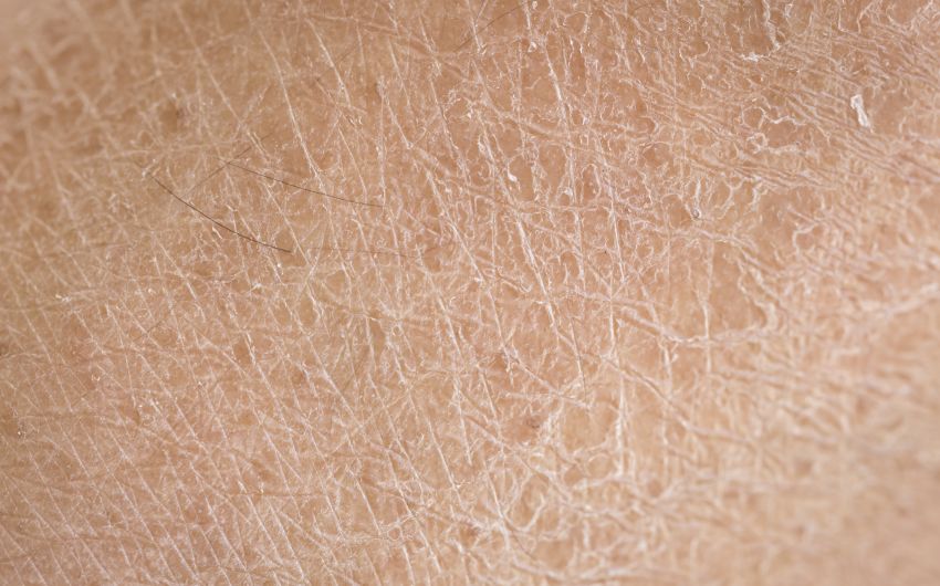 Nahaufnahme menschlicher Haut, die sehr trocken ist, schuppenartig verhornt aussieht und sich an wenigen Stellen leicht abschuppt.