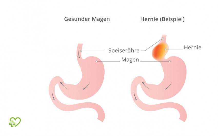 Illustration: Bei einer Hiatushernie wölben sich Teile des Magens in den Brustraum vor.