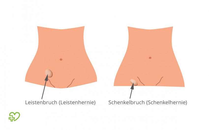 Typische Positiion von Leistenbruch und Schenkelbruch