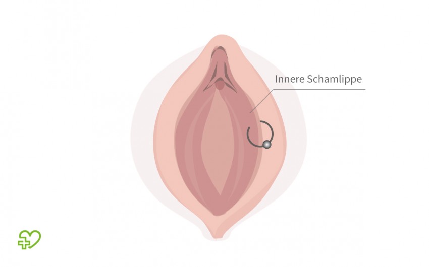 Grafische Darstellung: Piercing der inneren Schamlippe