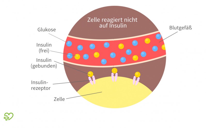 diabetes mellitus 2 symptome