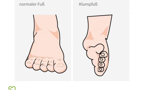 Normaler Fuß und Klumpfuß