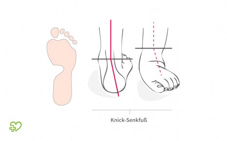 Schematischer Abdruck und Profil eines kindlichen Knicksenkfußes.