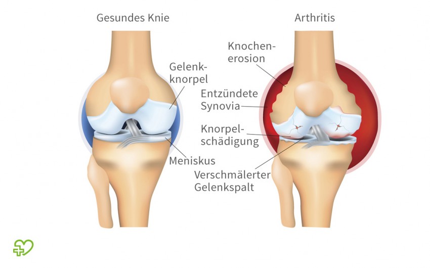 Wenn Keime in das Kniegelenk gelangen oder wenn das Immunsystem fälschlicherweise die eigenen Gelenke angreift (z.B. bei Rheuma), kann sich das Knie entzünden. Das Knie ist dann geschwollen und gerötet. Je nach Ursache und Stadium gibt es zahlreiche Medikamente, die helfen können – zum Beispiel Schmerzmittel oder Kortison.