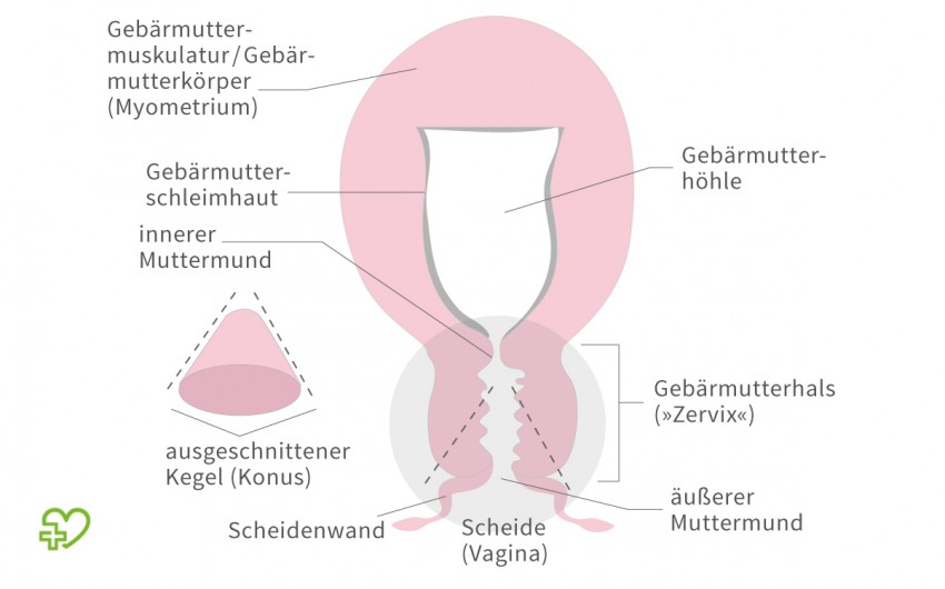Konisation (Therapieverfahren) bei Gebärmutterhalskrebs