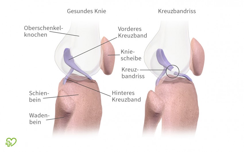 Ein Kreuzbandriss ist eine der häufigsten Knieverletzungen beim Sport – meist verursacht durch eine "unglückliche" Bewegung mit dem Knie. In dem Moment, in dem das Band reißt, hört man einen lauten Knall. Wenig später schwillt das Knie an und wird instabil. Nicht jeder Kreuzbandriss muss operiert werden. Die Behandlung hängt unter anderem vom Ausmaß und von den Bedürfnissen des Patienten ab.