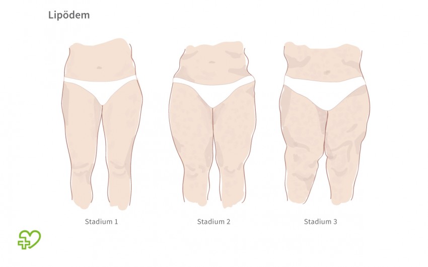 Lipodem Symptome Stadien Behandlung Onmeda De