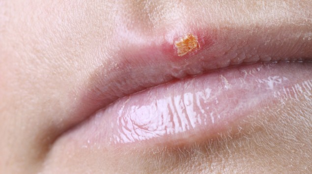 ständig lippenherpes