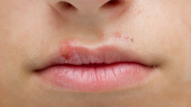 Lippenherpes Behandlung Verlauf Ursachen Onmeda De