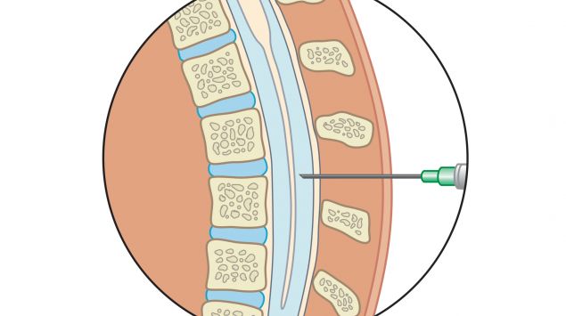 Man sieht die schematische Darstellung eine Lumbalpunktion.
