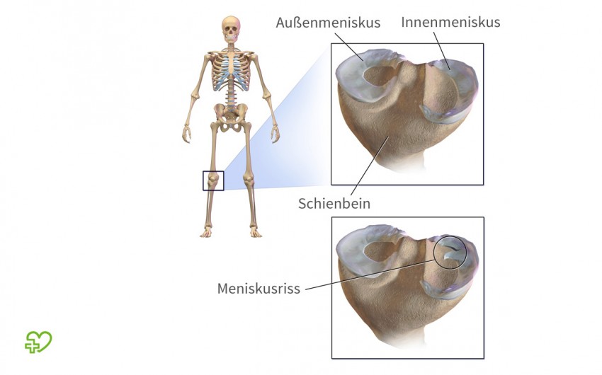 Menisken dienen als eine Art "Stoßdämpfer" im Kniegelenk. Plötzliche Drehbewegungen und abrupte Bewegungsstopps beim Sport können dazu führen, dass die Menisken einreißen – besonders oft ist der Innenmeniskus betroffen. Typisch für diese Verletzung sind akute Schmerzen und eine Schwellung des Kniegelenks. Die Mehrzahl der Meniskusschäden muss operiert werden.