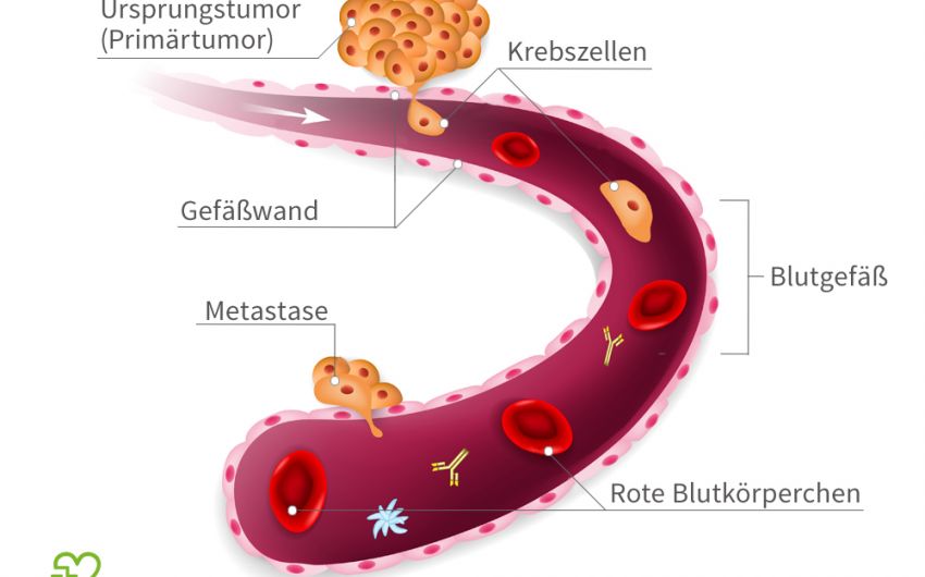 Bestimmte Krebszellen können die Wand eines Blutgefäßes durchdringen, mit dem Blutstrom in andere Körperregionen gelangen und dort Metastasen bilden.