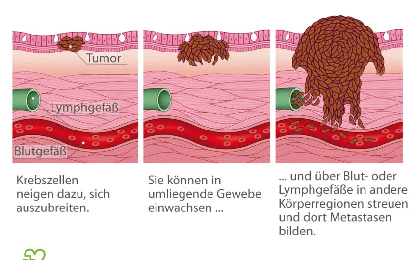 Metastasenbildung am Beispiel von schwarzem Hautkrebs: Einzelne Krebszellen lösen sich vom Ursprungstumor und können so in andere Körperbereiche streuen.