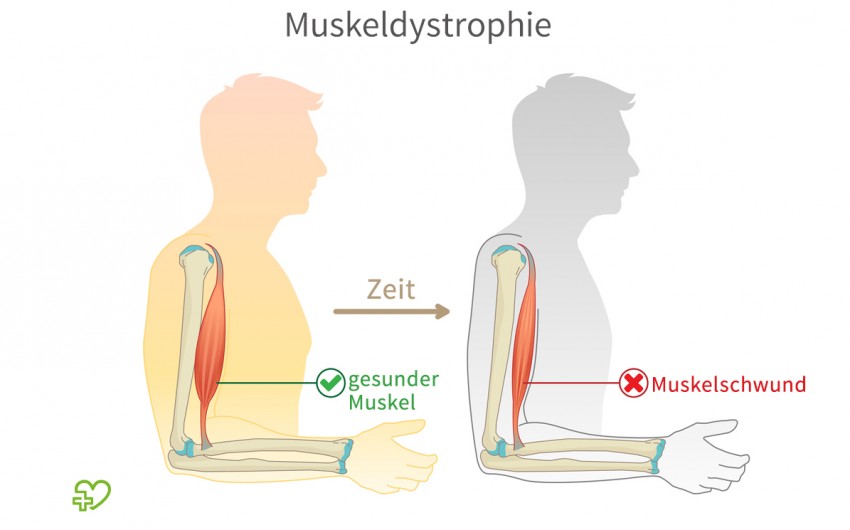 Man sieht eine Illustration zum Thema Muskeldystrophie.