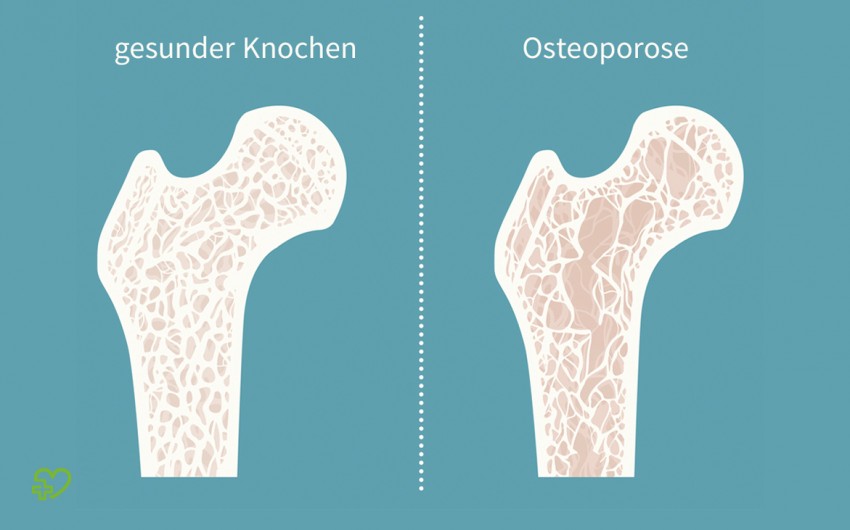 Man sieht die grafische Darstellung eines gesunden Knochens und eines Knochens mit Osteoporose.