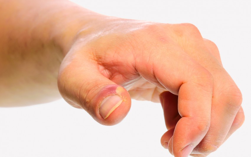 Bei dieser Nagelbettentzündung am Daumen hat sich bereits ein Abszess gebildet.