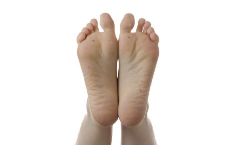 Dornwarzen: Man sieht Plantarwarzen auf den Fußsohlen.