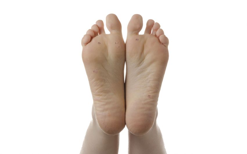 Dornwarzen: Man sieht Plantarwarzen auf den Fußsohlen.
