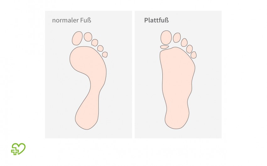 Im Vergleich: skizzierter Abdruck von normalen Füßen zu sog. Plattfüßen