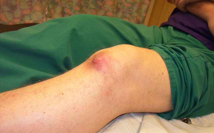 Von einer Pseudogicht spricht man, wenn sich Kalziumkristalle im Gelenkknorpel ablagern. Warum dies geschieht, ist häufig unklar. Typische Symptome wie plötzliche Schmerzen und eine Schwellung treten erst dann auf, wenn die abgelagerten Kristalle den Knorpel zerstört haben. Nicht-steroidale Antirheumatika (NSAR) und – im chronischen Stadium – eine Operation können die Beschwerden lindern.