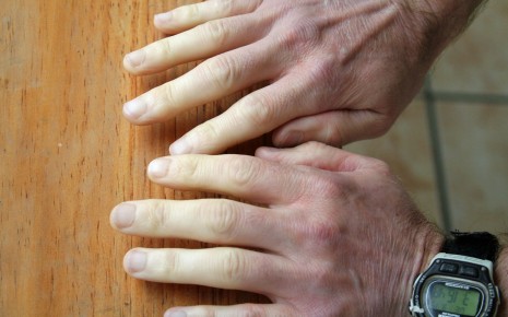 Durchblutungsstörung der Finger beim Raynaud-Syndrom
