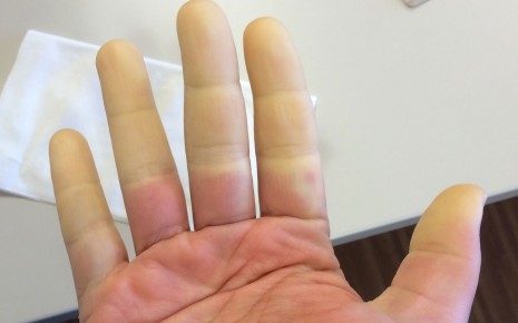Durchblutungsstörung der Finger bei Raynaud-Syndrom