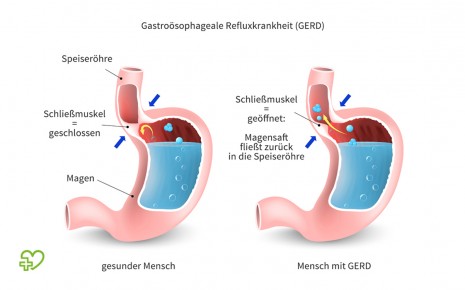 Trinken Sie Reflux und Gewichtsverlust