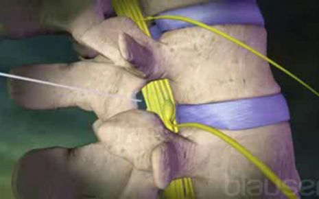 Spinalanaesthesie,Video
