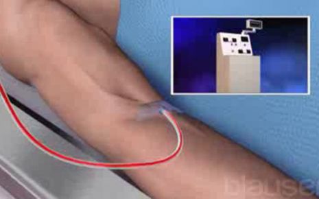 Allogene Stammzelltransplantation Video