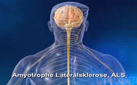 ALS amyotrophe Lateralsklerose Video